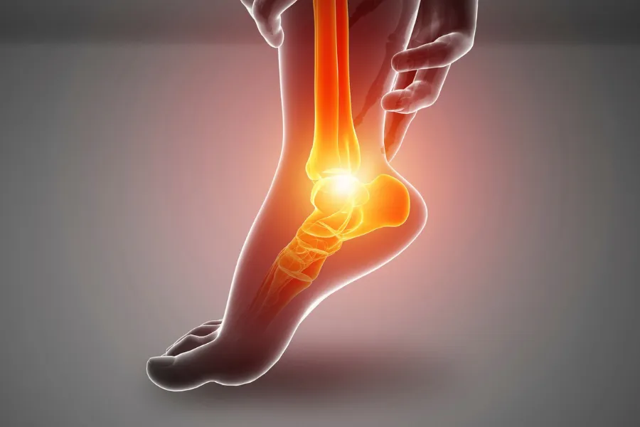 Plantar Fascilitis