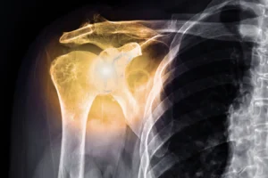 X-ray illustrating shoulder joint inflammation treated with low-dose radiotherapy (LDRT)